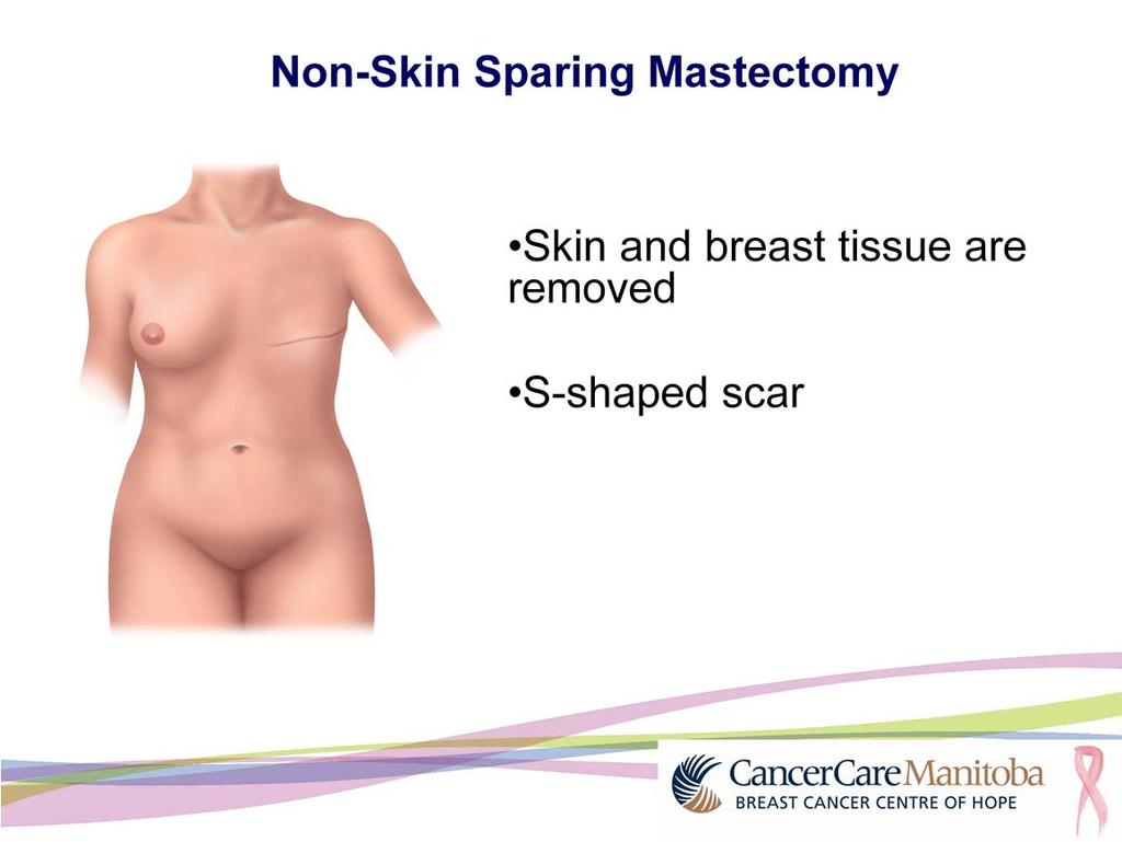 With a non-skin sparing mastectomy, the skin, breast tissue, nipple and areola