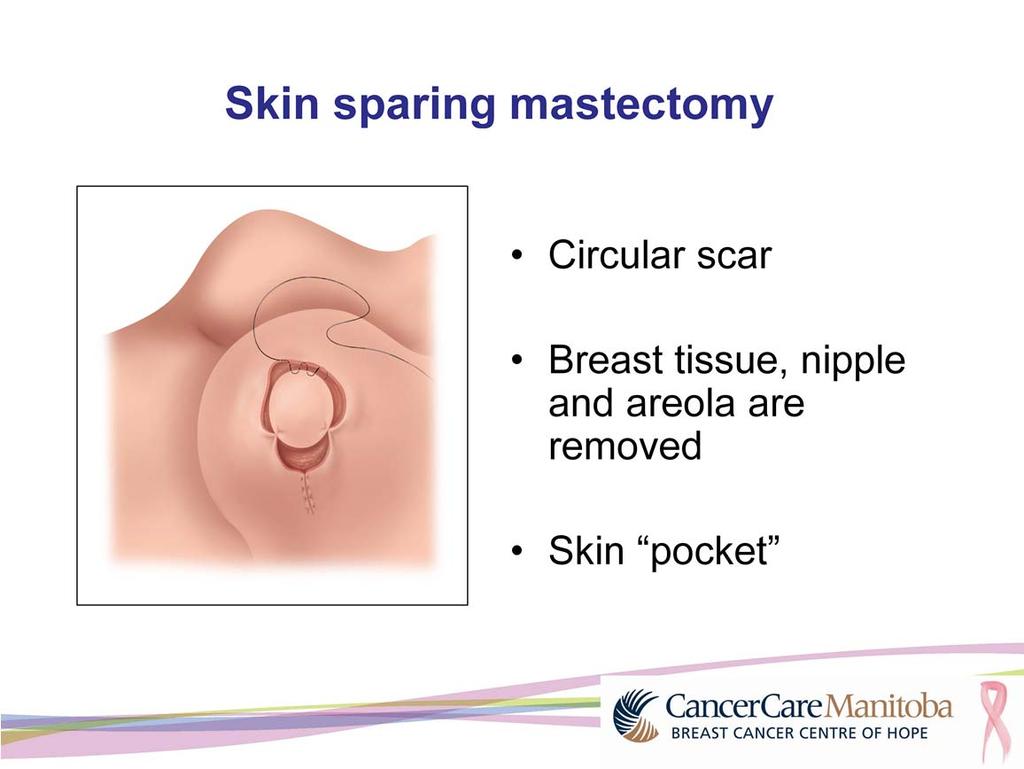 If you have breast reconstruction at the same time as your mastectomy, your surgeon will do a skin sparing mastectomy.