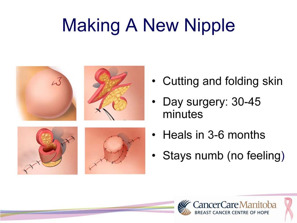 The next step is to make a new nipple. This is done by cutting and folding the skin on the center of the reconstructed breast. This picture shows one way to make a nipple.