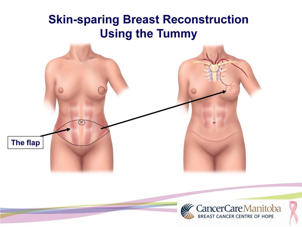 This picture shows the incisions on the breast and tummy for a skin sparing breast reconstruction. It is often called the tummy tuck. The tummy incision will be from hip to hip.