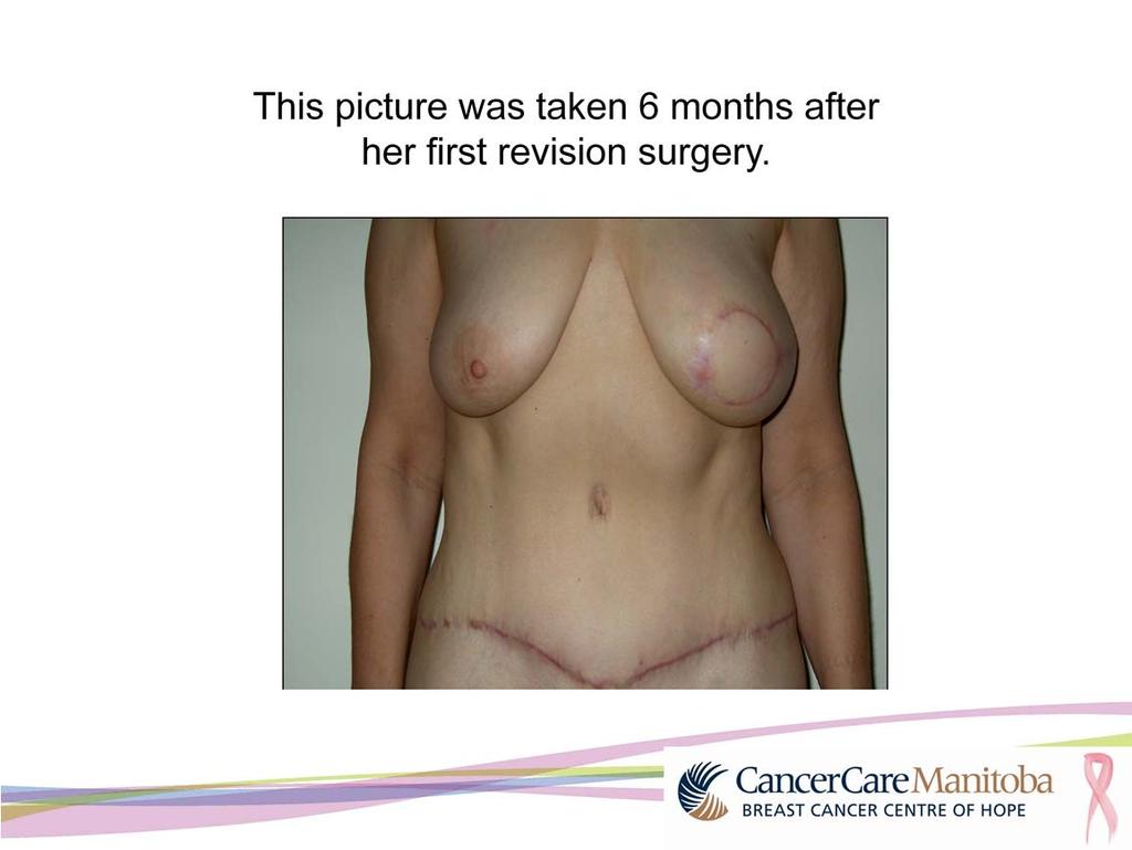 This lady was told she had just enough tummy tissue and her tummy area was quite tight after surgery until things healed and stretched.