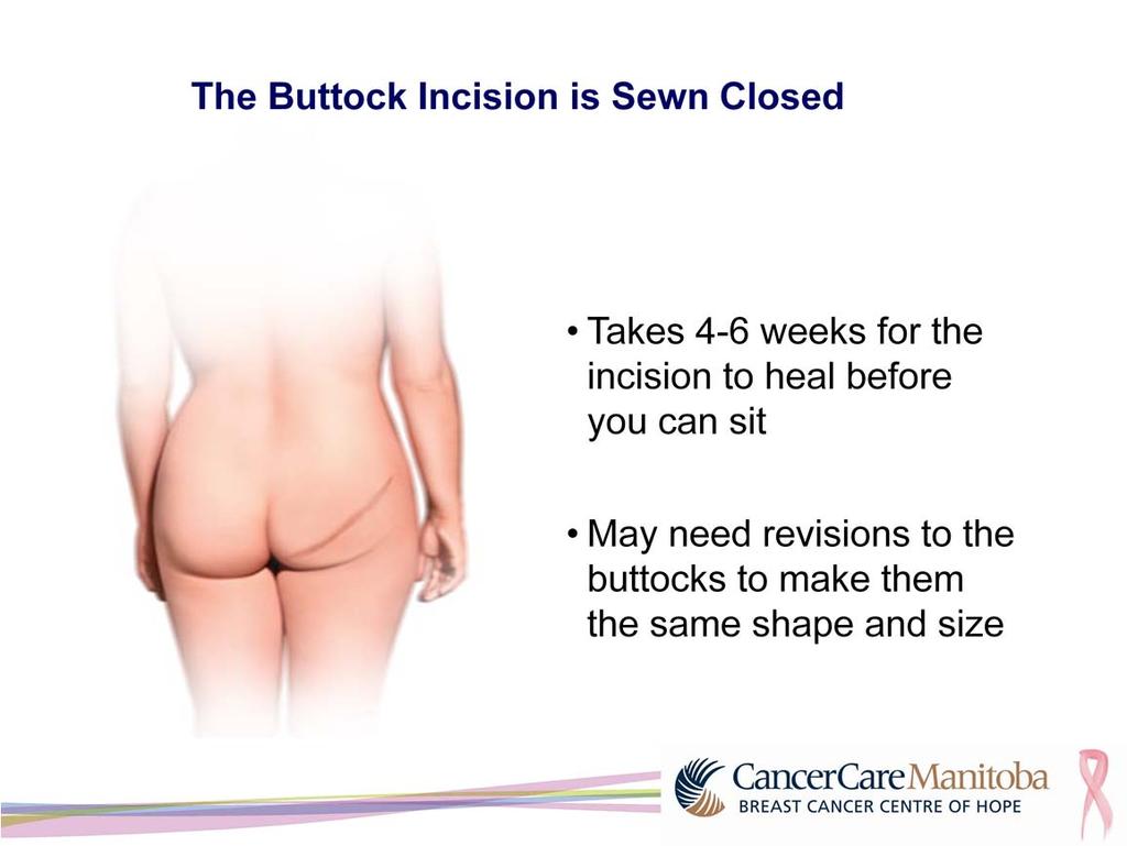 Once the area is closed with stitches, there will be a large scar across the buttock cheek. Part of the recovery will be lying on your back or standing.