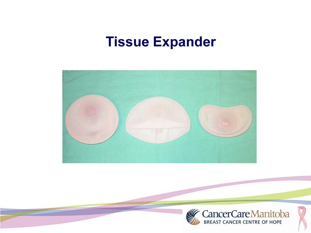 First, a temporary tissue expander is put in place and it will eventually be replaced with a permanent implant.