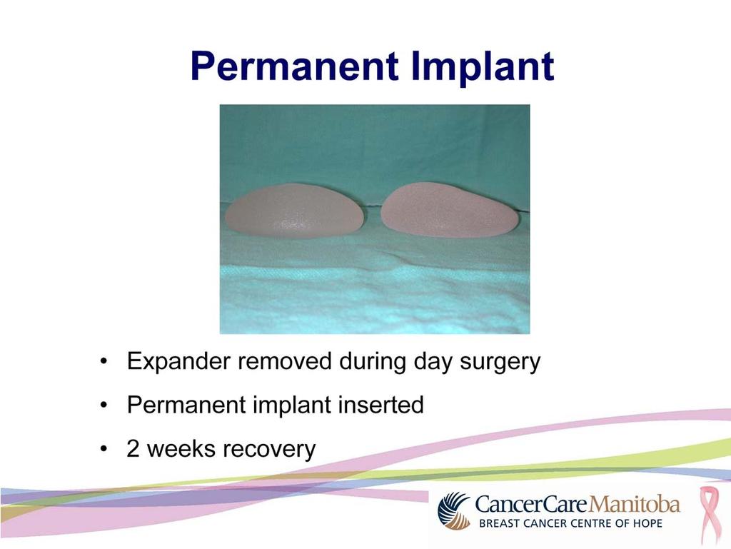 The expander will be removed in day surgery and a permanent implant will be inserted. Recovery will take approximately two weeks.