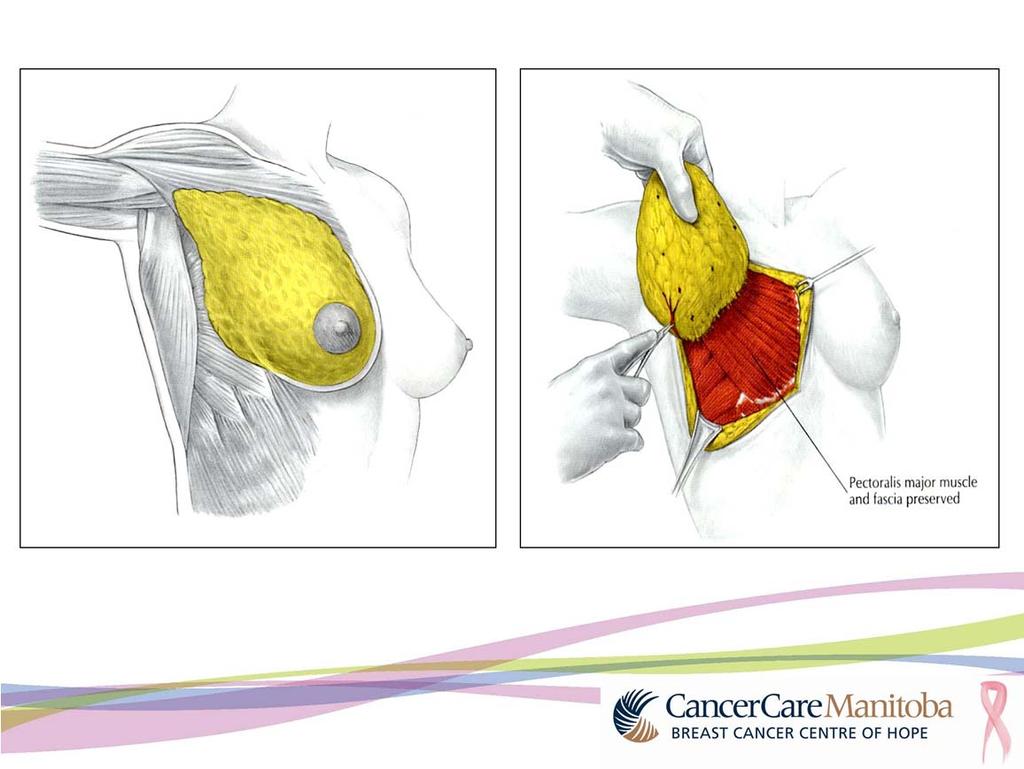 A mastectomy is the removal of breast tissue including the nipple and areola, the colored area around your nipple.