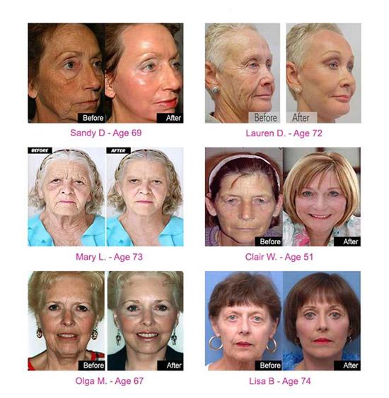 ADVERTISEMENT REGISTER LOGIN HOME FITNESS GOSSIP RECIPIES YOGA PARENTING FASHION HOME Anti-Aging Tuesday, August 11th, 2015 70 Year Old Women Look 40 Again: You Will Not Believe Their Transformations!