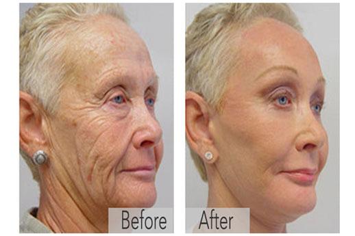 product that erases years off her face for only a few dollars. Read on to find out how it works! "Lauren di Fiores was able to remove over 20 years of aging from her face with just one simple product!