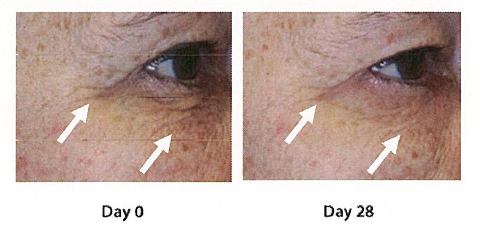 Anti-wrinkle effect with lines