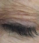 83% CROW S FEET, LINES AND WRINKLES AROUND EYES