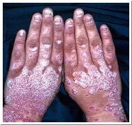 Psoriasis rarely on the face, lesions are round, dry patches