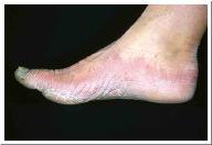 Tinea Pedia ringworm of the foot