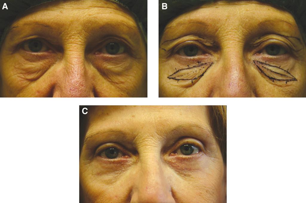 Bellinvia et al 667 Figure 3. (A) This 62-year-old woman presented for treatment of upper and lower eyelids region. (B) The patient s preoperative markings are shown.