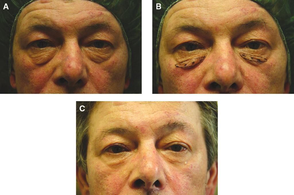 668 Aesthetic Surgery Journal 30(5) Figure 4. (A) This 59-year-old man presented for treatment of lower eyelids region. (B) The patient s preoperative markings are shown.
