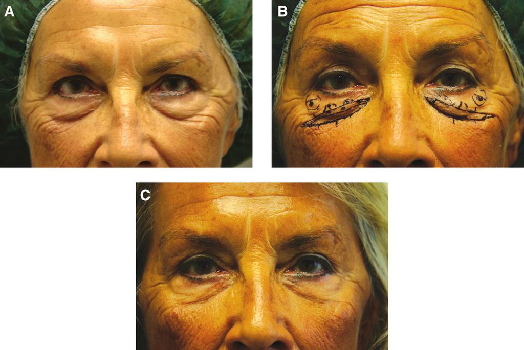 Bellinvia et al 669 Figure 5. (A) This 63-year-old woman presented for treatment of lower eyelids region. (B) The patient s preoperative markings are shown.