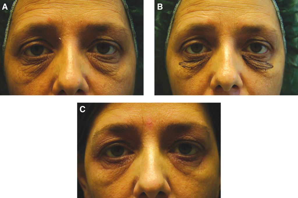 670 Aesthetic Surgery Journal 30(5) Figure 6. (A) This 35-year-old woman presented for treatment of lower eyelids region. (B) The patient s preoperative markings are shown.
