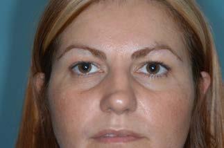 FEES: The cost of blepharoplasty / Eyelid surgery / Eyelid lift is: Upper or lower eyelid
