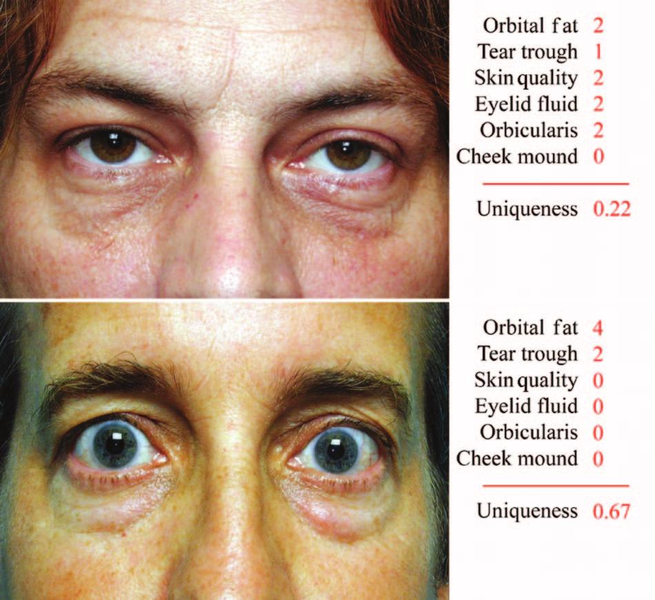 Vol. 115, No. 5 /WHAT CAUSES EYELID BAGS? 1399 FIG. 5. Uniqueness score calculation (maximum score/ sum of all six scores).