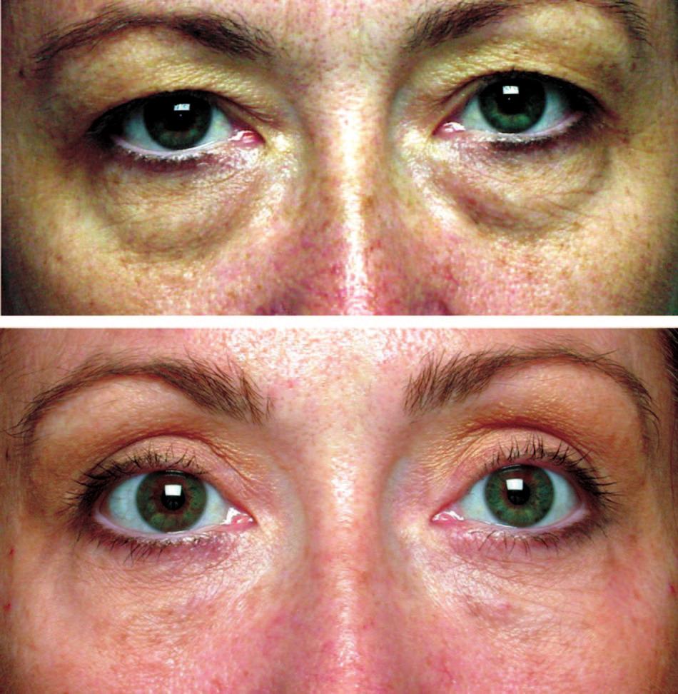 1400 PLASTIC AND RECONSTRUCTIVE SURGERY, April 15, 2005 was r 0.45 (p 0.001). Interobserver correlations greater than 0.70 are desired; this was achieved only in the eyelid fat category.
