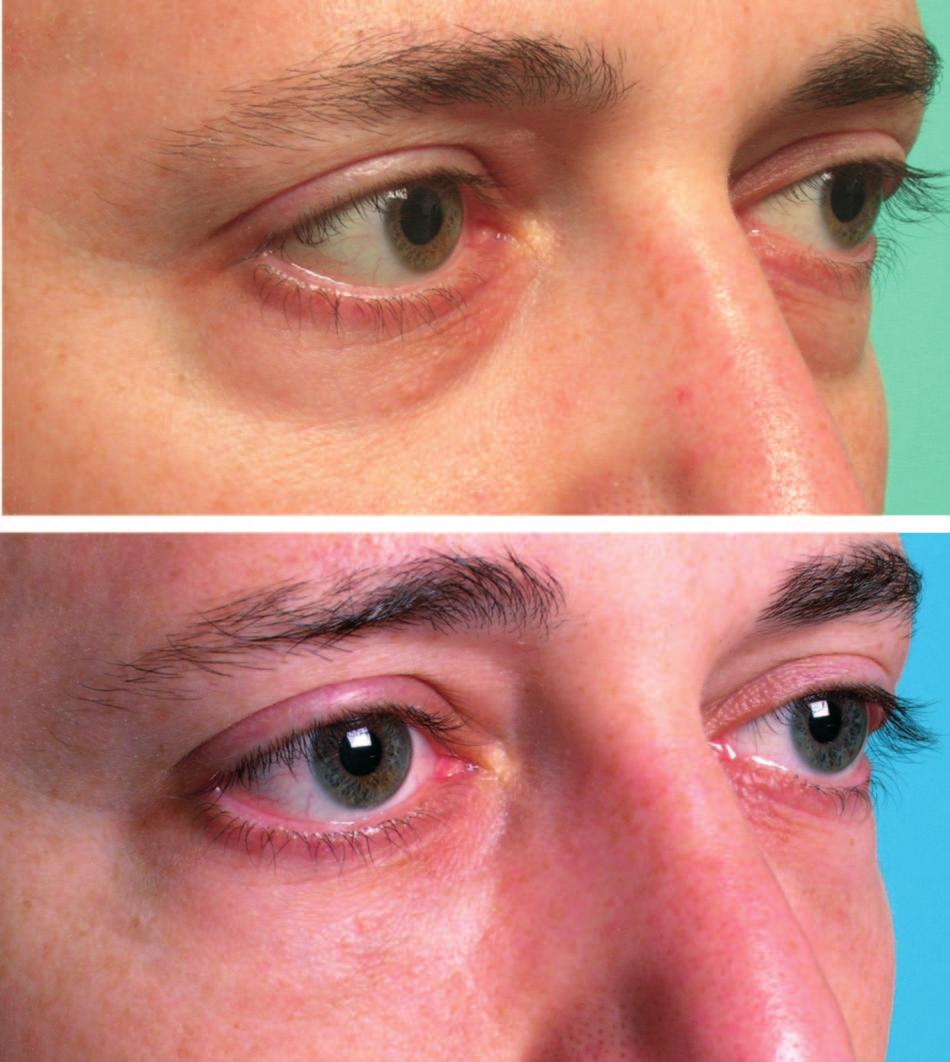 This patient with loss of skin elasticity is seen before (above) and 3 months after (below) chemical peel.