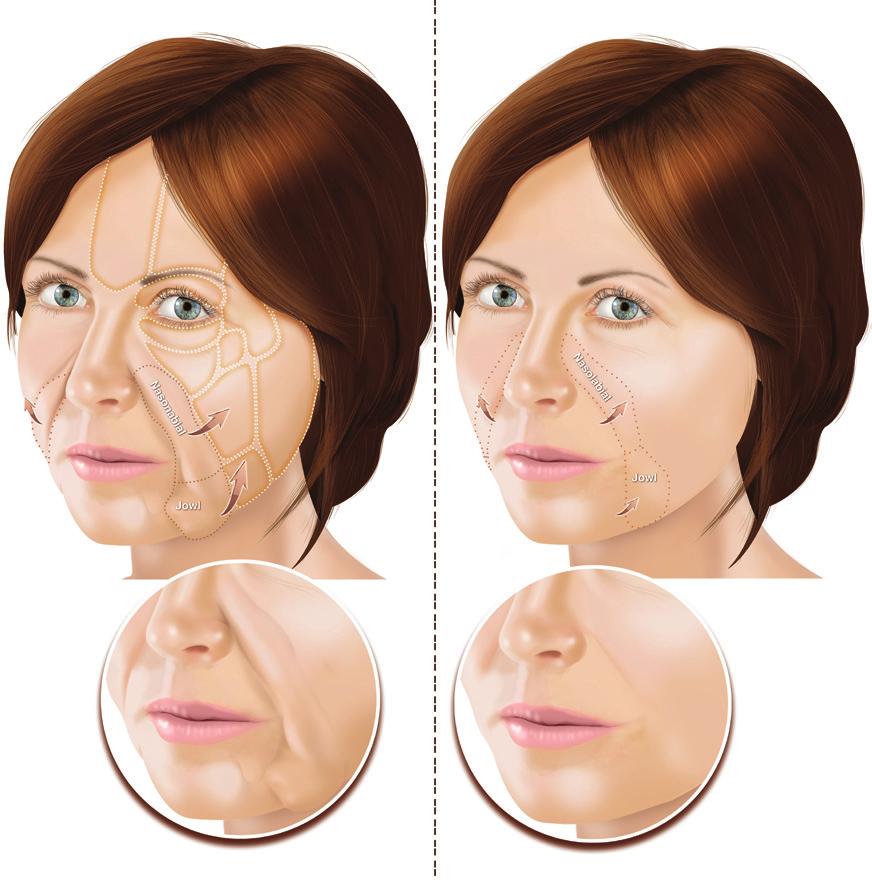 Bellity P et al. Facial rejuvenation enhancing cheek lift Fig. 1. Correction of nasolabial and jowl fat descent These fat areas are visible and have initiated a downward displacement. Fig. 2.