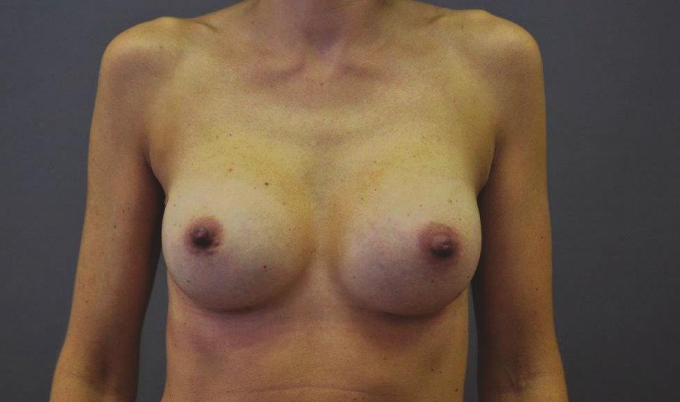 This may be due to a previously undetectable chest wall abnormality, increased swelling on one side, the implant changing position, the result of some blood or wound fluid collecting in the wound, or