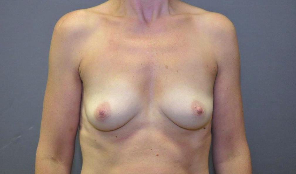 The thickness of your breast tissue (above and to the side of your nipple) The laxity of the skin of your breast Sometimes your chest wall circumference No-one has two breasts that are exactly the