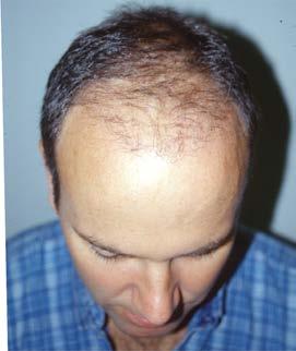 That s why men with advanced balding often only have hair around the sides and back of their head.