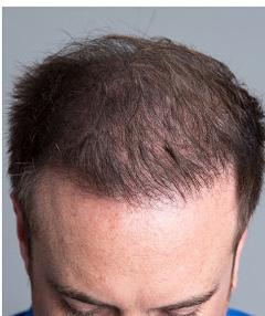 treatments can be effective in preserving the hair you have, the only permanent solution for restoring your lost hair is surgical hair restoration.