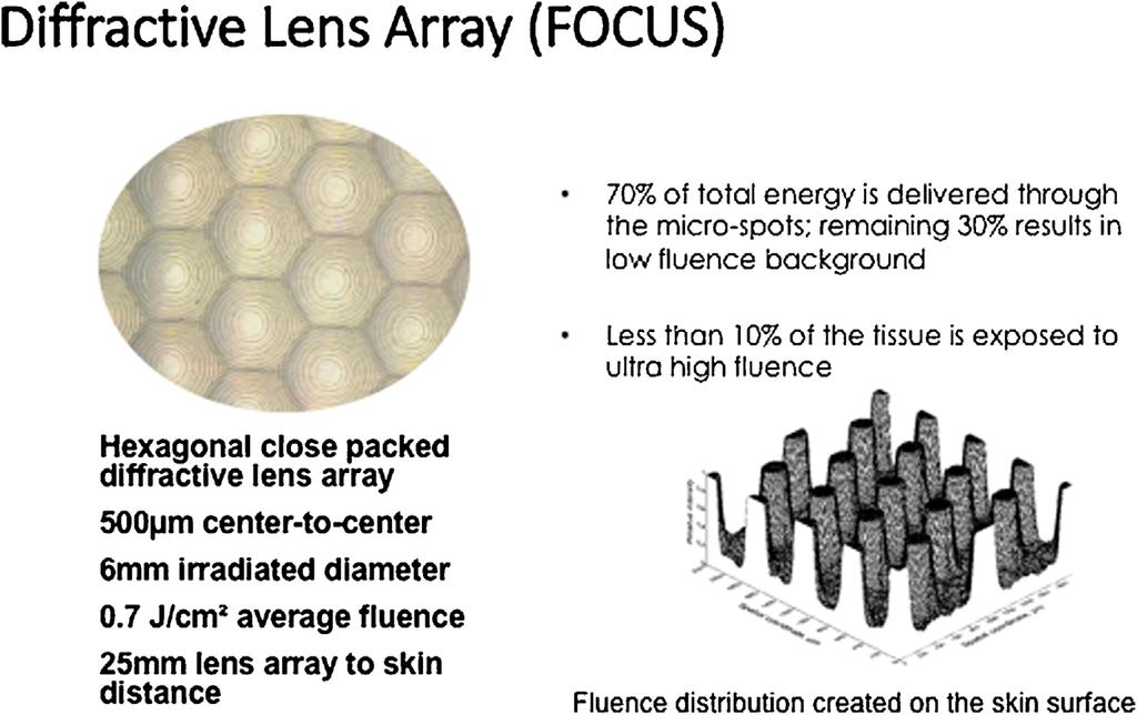 PICOSECOND TREATMENT OF WRINKLES WITH NOVEL LENS 41 Fig. 1. Diffractive lens array.
