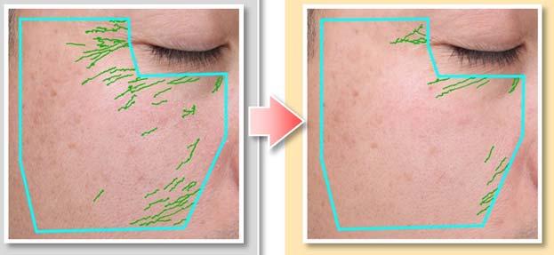 0% was applied on the cheek of a volunteer (20 s to 40 s) twice a day (morning/ afternoon) for 6 weeks. Wrinkle score and Texture score were measured by VISIA evolution (Canfield Scientific Inc.). The green marks in the left figure indicate scanned wrinkle part.