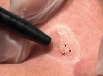 Treatment Tips - continued Milia removal - Insertion technique Insert into skin @ 45 degree angle / Use insulated probe/needle No water on the area Use LO current (100v) - push bottom button Insert