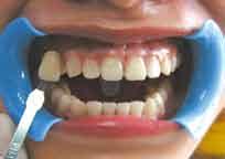 teeth. Finally I heard about the BEYOND WhiteSpa system.