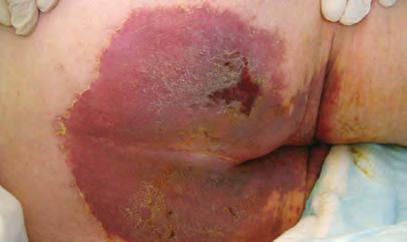 Satellite lesions are typically present.