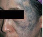 INDICATIONS Benign Pigmented Lesions Using a nanosecond laser pulse- the gold standard for treating