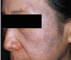 including: Solar lentigos Lesions affecting the oral mucosa and the lips Deeper lesions such as