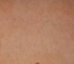 CAFE AU LAIT MELANOCYTIC HYPERPLASIE After After TATTOO REMOVAL NEVUS OF OTA After 7 Treatments