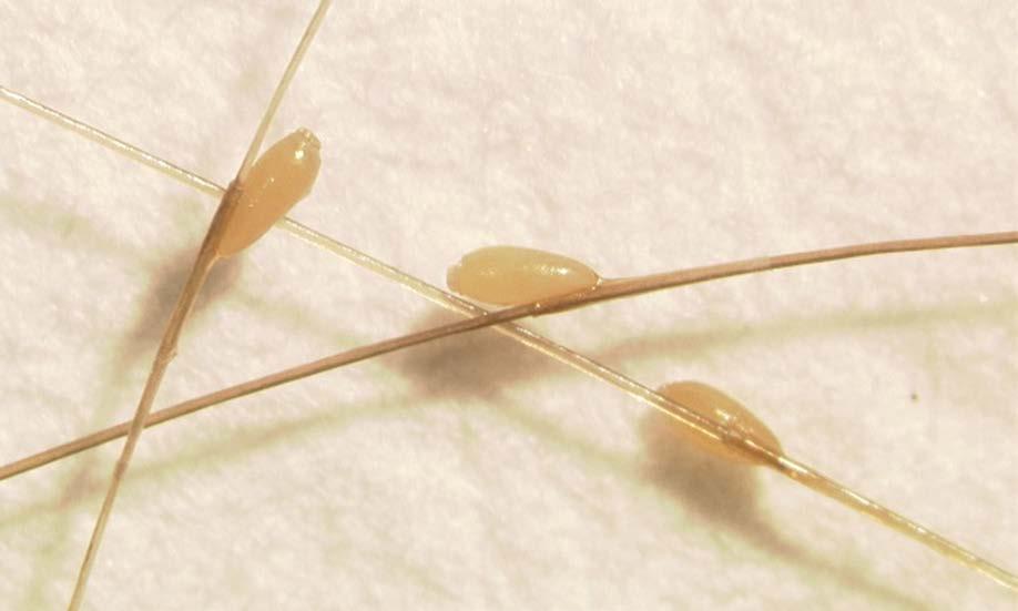 Head lice nits Shujuan Li, University of Arizona Females attach nits to hair 1 mm from the scalp.