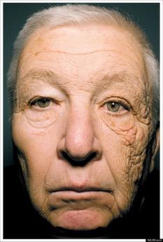 69 year old truck driver - Bill McElligott UVA rays exposure for 28 years while driving Unilateral