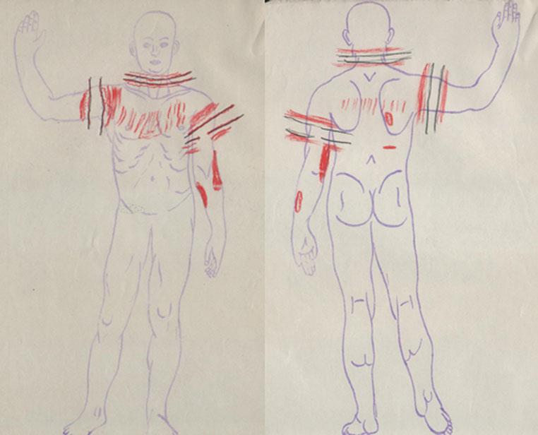Fig. 4 The two diagrams of the anterior and posterior body. The body separation lesions are marked in red pencil Fig.