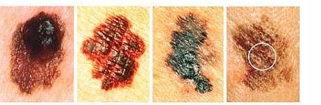 Asymmetry Border Color Diameter Another very important sign of possible melanoma is a change in the size, shape, or color of a mole or the appearance of a new spot.