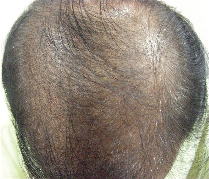 A 40 year old male with female pattern type III of hair loss Figure 5