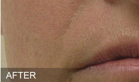 Remove debris from pores with painless suction.