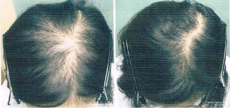 Mesotherapy RF in Trichology Before/After