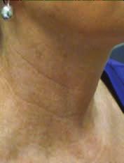 old Acne Scarring Neck Lines Hair Loss