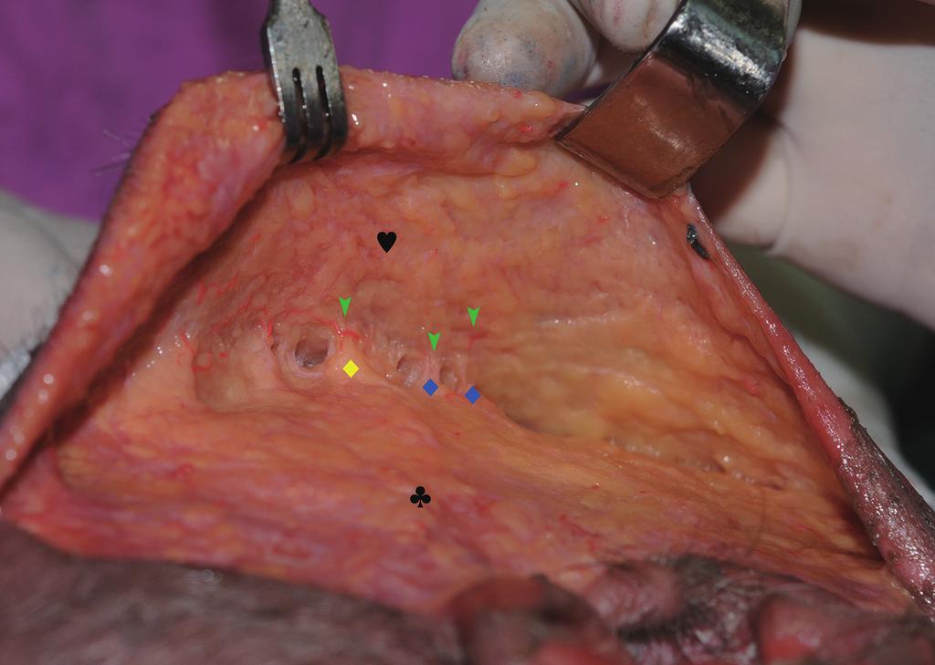 Alghoul and Codner [30] also emphasized that finding this patch, which is believed to be the perforator of the transverse facial artery, during exploration alerts the surgeon to the presence of blood