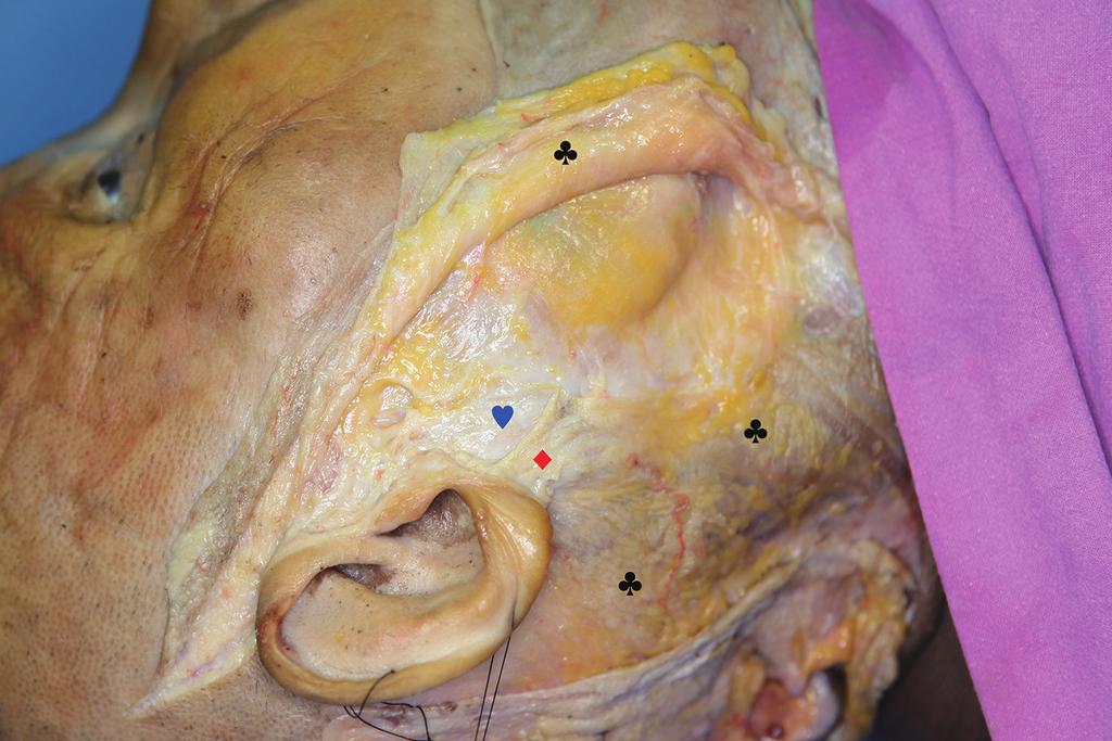 Upon finding McGregor s cutaneous ligaments, they mentioned 3 nearby structures of importance: the transverse facial artery, parotid duct, and zygomatic branch of the facial nerve that penetrates the