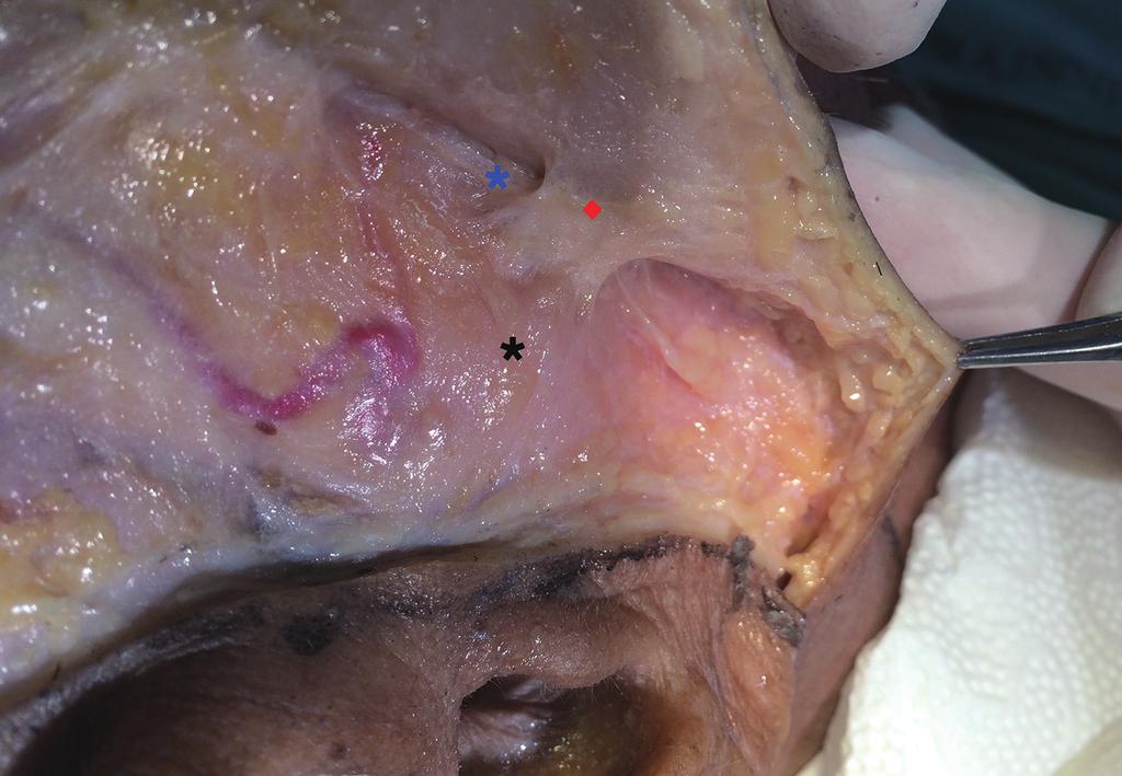 ligament [8]. Reports differ with regard to the origin of the masseteric cutaneous ligament: whether it arises along the anterior border of the masseter muscle [5,8,36] (Fig.