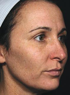 This has become our mainstay approach for melasma and treating PIH, especially in darker skin types because it is effective, yet gentle. By Kevin A. Wilson, Contributing Editor Roy G. Geronemus, M.D.