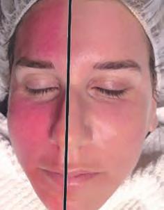 Having a product that covers the redness so well, and can match any skin tone makes the downtime less scary. In addition, patients can return to their normal daily routine much sooner.