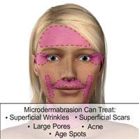 Microdermabrasion Introduction Microdermabrasion is one of the most popular non-invasive cosmetic procedures performed today.